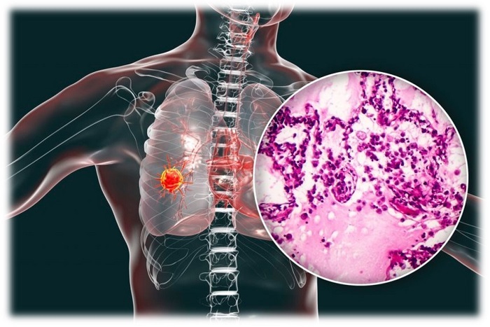 با این تست ۵ ثانیه‌ای، سرطان ریه را تشخیص دهید +عکس